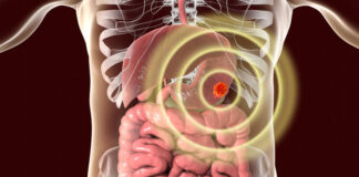 Simptomi raka želuca se često previde! Što još trebate znati o ovoj teškoj bolesti?