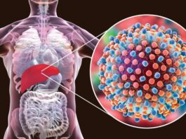 Hepatitis – virusni, bakterijski, autoimuni, alkoholni