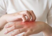 Seboroični dermatitis – uzroci, simptomi, liječenje