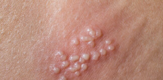 Genitalni herpes – simptomi, prevencija, liječenje