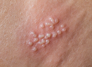 Genitalni herpes – simptomi, prevencija, liječenje