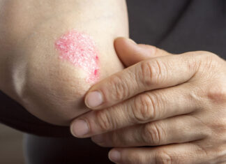 Psorijaza – sve šta trebate znati o psorijazi