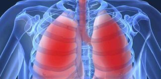 Upala pluća (Pneumonija): Simptomi, prevencija i liječenje