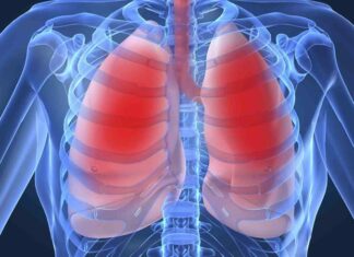 Upala pluća (Pneumonija): Simptomi, prevencija i liječenje