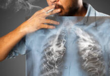 Rak pluća – simptomi i liječenje