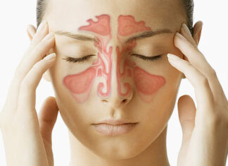 Sinusitis
