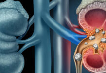 Ovo su rani i skriveni znaci raka bubrega koji se često ignorišu