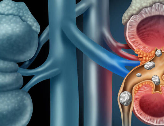 Ovo su rani i skriveni znaci raka bubrega koji se često ignorišu