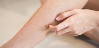 Ekcem – Simptomi, Opis, Liječenje