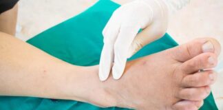 Kožna gangrena – simptomi, liječenje, prevencija