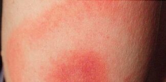 Borelioza – lajmska bolest