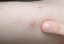 5 činjenica koje biste trebali znati o vodenim kozicama