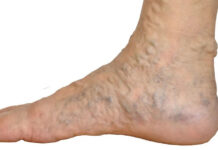 Začepljenje krvnih žila u nogama