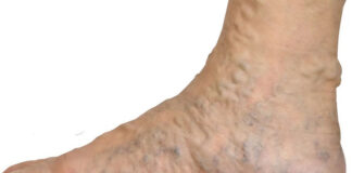 Začepljenje krvnih žila u nogama