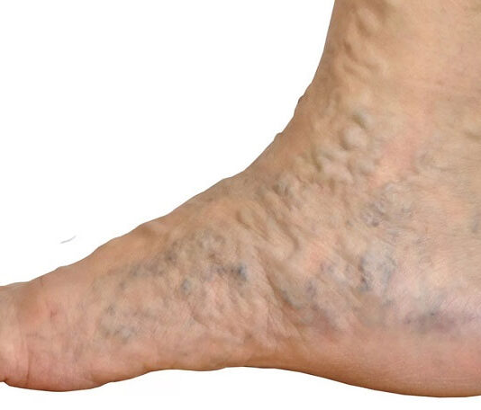 Začepljenje krvnih žila u nogama