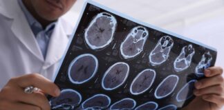 Multipla skleroza – koliko dugo živim s ovom bolešću?